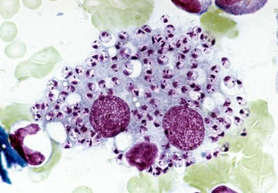 Mikroskopowy obraz wymazu barwionego barwnikiem Giemsy, przedstawiający amastigoty Leishmania wraz z cytoplazmą komórek przy leiszmaniozie u psa