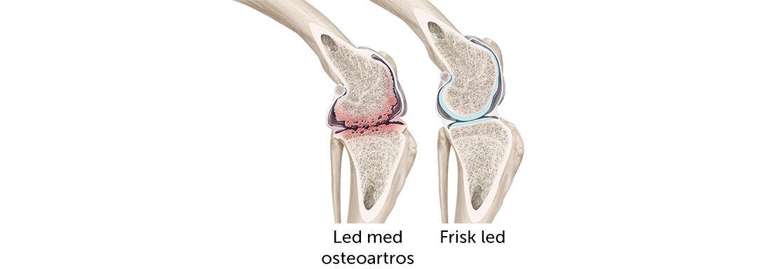 Led med osteoartros och frisk led