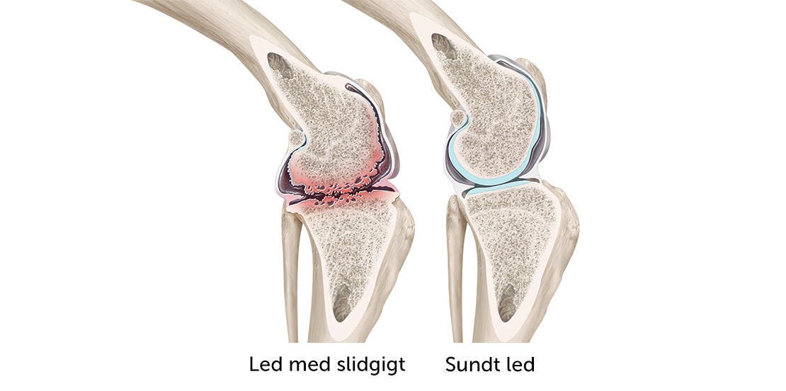 Illustration af led med slidgigt
