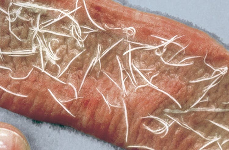 Hookworms in the intestinal tract