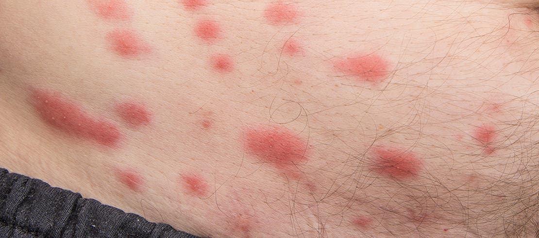 An image of flea bites on human skin 