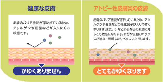 健康な皮膚・アトピー性皮膚炎の皮膚
