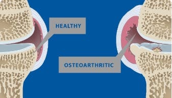 Healthy joint and an osteoarthritic joint. 